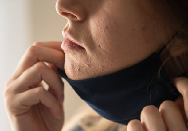 Woman with acne and irritation from wearing a mask having Acne Treatment In Chicago